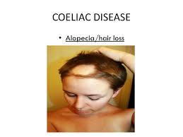 Anemia, usually from iron deficiency. Cwest Coeliac Disease What You Will Learn Today In This Cwest Presentation You Will Discover What Coeliac Disease Is The Associated Conditions With Ppt Download