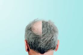 Hair Loss Treatment Houma La Medical Treatment For Hair Loss