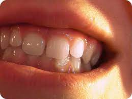 Children who do not have their overbites corrected are more likely to need jaw surgery as. What Is An Overbite And How Is It Corrected Westermeier Martin Dental Care
