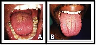 Image result for Fissured tongue
