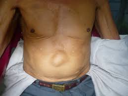 Hernia Epigástrica – Coloclinic