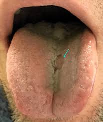 Image result for Primary Syphilis