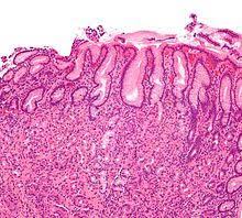 Gastritis Wikipedia