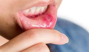 If you suspect that you have vaginal thrush, speak with your doctor so you can get medical treatment. How To Deal With Oral Thrush Istanbul Dental Care