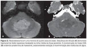 scielo brasil meduloblastoma correlacao entre ressonancia magnetica convencional difusao e espectroscopia de protons meduloblastoma correlacao entre ressonancia magnetica convencional difusao e espectroscopia de protons