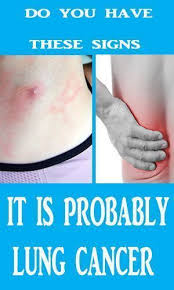 Catching this type of lung cancer early is critical, and the symptoms to look for include: Pin On Remedies And Beauty