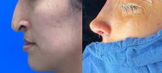 Example of Nasal Reconstruction