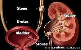 Pin By Sherry Lynn On Ssss In 2020 Treat Kidney Stones Prostate Surgery Ayurvedic Treatment