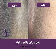 لیزر واژن بیکینی قبل و بعد