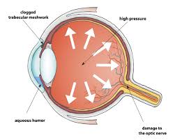 Glaucoma is a group of eye diseases which result in damage to the optic nerve and cause vision loss. What Is Glaucoma Patients De Ceunynck Ophthalmology