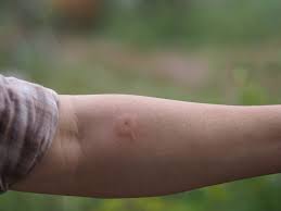 Image result for ant bite
