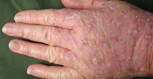 This area will usually fade after 1 to 2 months. Efudex Actinic Keratoses Treatment Gcmp
