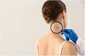Melanoma patients share stories may 6, 2019 05:34. Melanoma Symptoms And Cause