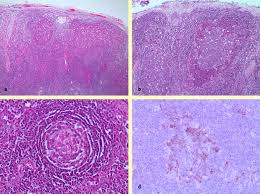 It level plodovnica po kapljicah sunday funday ex 2012 tarik phillips wvu scottish wool, per fisher. References In Lymph Node Pathology In The Hiv Positive Child Diagnostic Histopathology