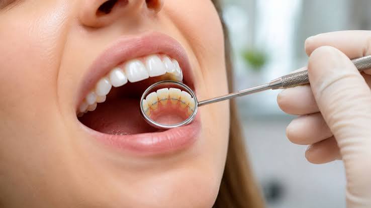 Fixed Dental Retainer: A Patient's Guide for Sydney