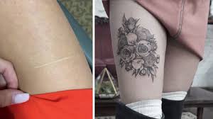 To answer, yes you can tattoo over scars. Philadelphia Tattoo Studio Offers Free Services To Cover Self Harm Scars