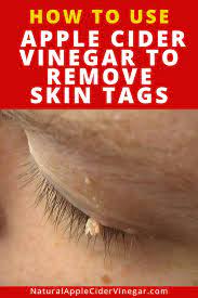 How To Use Apple Cider Vinegar To Remove Skin Tags Skin Tag Removal Skin Tag Removal Remedies Skin Tag