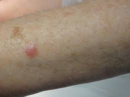 Melanoma is a skin cancer usually caused by ultraviolet rays from the sun or tanning beds. Non Melanoma Skin Cancer Nmsc South East Dermatology