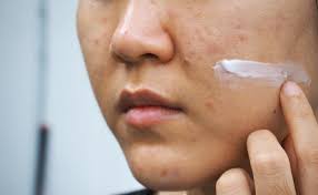 Buatlah masker dari 1 sendok makan. Penyakit Milia Penyebab Tanda Tanda Dan Cara Menghilangkannya