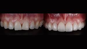 To get the most out of your pull, try pinching the tooth at the base to get a firm grip. Periodontal Splinting Of Teeth Anderson Lake Dental