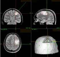 Klinik Und Poliklinik Fuer Neurochirurgie Gliome