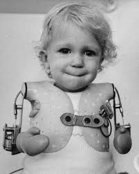 Doctor protects children from thalidomide