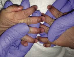 Image result for Supernumerary Digit