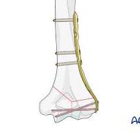 Lateral plating
