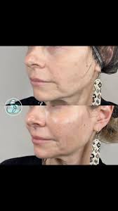 Filler should never look unnatural or noticeable!  😍🙌🏽@lindsaynp_skinesteem enhanced the natural beauty of her client with  just 1 vial of Radiesse to the cheek for their annual maintenance! , See  the ...