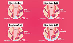 Aboral) der linea dentata, „innere oberhalb (proximal bzw. Was Sind Hamorrhoiden Alle Infos Auf Praxisvita De