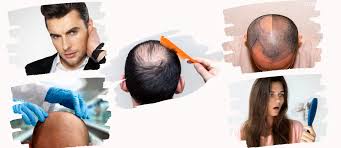 Clínica injerto capilar Vic➡Mejor clínica capilar, precios, opiniones.