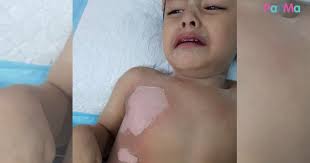Dia sembuh dengan buah ajaib ini! Terkena Air Panas Dari Penapis Air 97 Degree Badan Anak Melecur Second Degree Burn Pa Ma