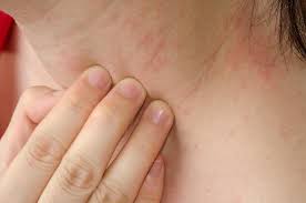 Allergic Eczema Causes Symptoms And Pictures