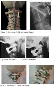 Grátis: FRATURA DE COLUNA - Material Claro e Objetivo em PDF para Estudo  Rápido