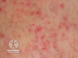 Image result for sweat rash on back