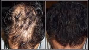 Apple Cider Vinegar Hair Loss Results Apple Cider Hair Loss Results Vinegar Apple Cider Vinegar Hair Loss Vinegar Hair Loss Vinegar Hair Rinse