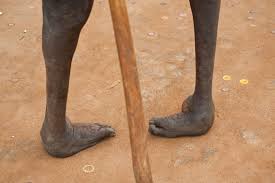 Congenital means present at birth, talipes means affecting the foot and ankle and. Learn About Clubfoot Deformity In Newborns