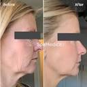 The Before and After of Morpheus8 Skin Tightening: SpaMedica's ...
