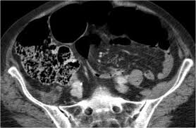 Pin By Omar Serhan On Diagnostic Medical Imaging Small Bowel Obstruction Bowel Obstruction Large Bowel