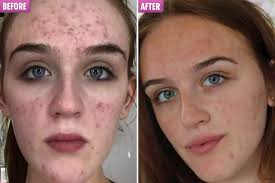 Tea tree oil can be used in a hair mask to help eliminate dandruff, dryness and itchy skin. Acne Sufferers Claim Carbon Theory S 14 Tea Tree Toner Cleared Spot Scars In Days And