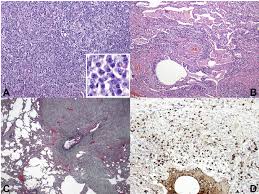 Intrapulmonary lymph nodes, or pulmonary lymph nodes, are normal lymph nodes found within the lung parenchyma itself. A Lymph Node Showing Expansion Of Interfollicular Areas The Inset Download Scientific Diagram