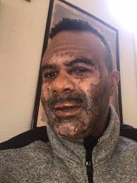 Can microwaved water explode in your face? Stockton man shares story