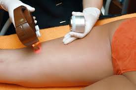 Epilation Laser Notre Avis Ce Que Vous Devez Savoir