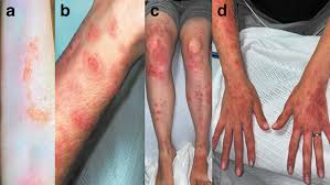 Image result for Rhus Dermatitis