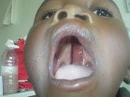 Resultado de imagen para paladar hendido