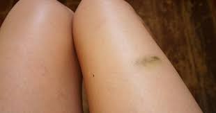 Leukemi symptomer kløe kjapp sunn og billig middag. Blamerker De Aller Fleste Blamerker Er Ufarlige Men Blamerker Sammen Med Andre Symptomer Bor Sjekkes