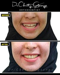 ✨ Smile transformation you don't want to miss! ✨ Here's the transformation  story of a young man who came to us with crowded, forwardly placed teeth  and a noticeable midline shift. He