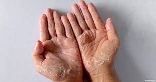 7 أسباب لتقشر جلد اليدين خلال تقلب الفصول والشتاء | سوبر ماما