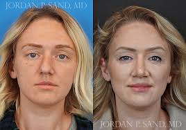 This beautiful patient never liked her nose. She felt it was too prominent  for her and very crooked. She also had a lot of difficulty breathing  through the nose. She wanted it