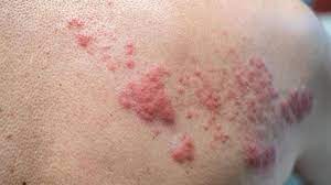 Que Es El Herpes Zoster Sintomas Causas Y Como Tratar La Enfermedad